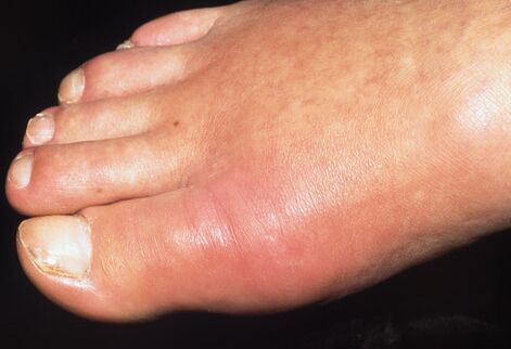 Akútna artritída pred liečbou sprejom Hondrox