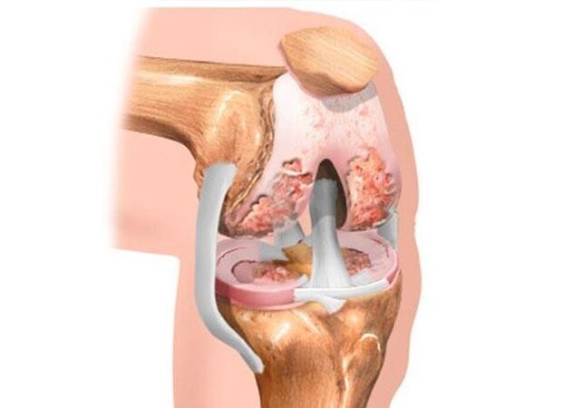 artróza kolena