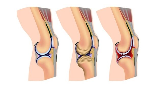 štádia artrózy kolenného kĺbu