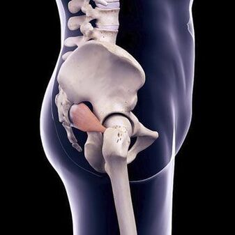 Bolesť chrbta s dýkou môže byť spôsobená spazmom piriformisového svalu