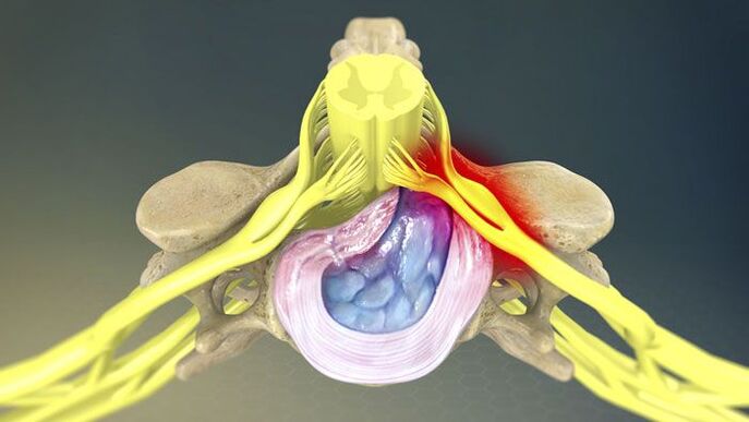 Jednou z príčin bolesti chrbta je herniovaný disk. 