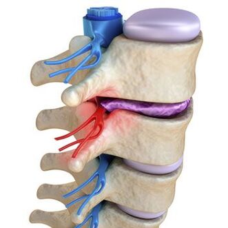 Zovretý nerv v chrbtici sprevádza vystreľujúca bolesť