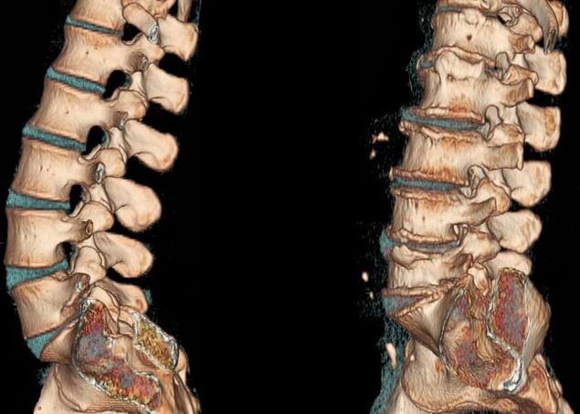 Osteochondróza bedrovej oblasti