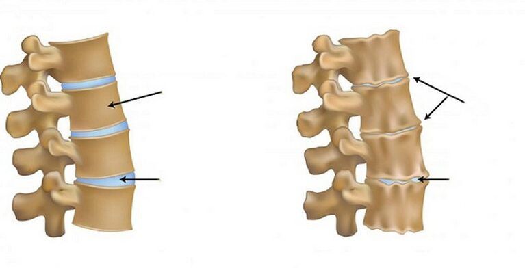 ischemický syndróm osteochondrózy