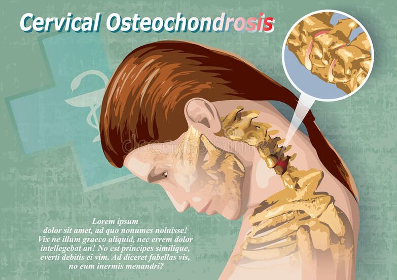 cervikálna osteochondróza je ochorenie chrupavkového tkaniva