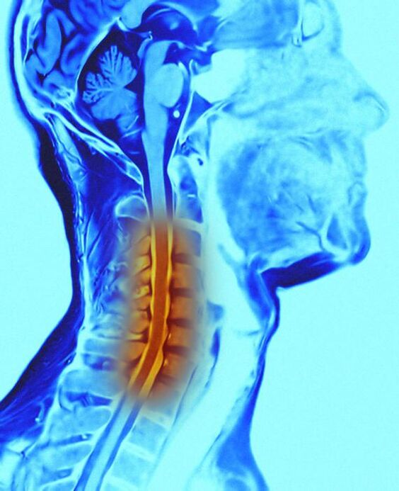 krčná chrbtica a osteochondróza